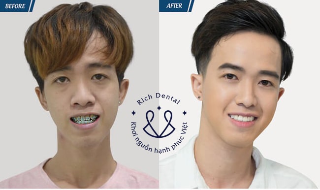 a tín, cho e xin họ và tên của bác sĩ chuyên niềng răng với a