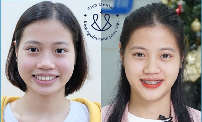 nieng-rang-co-lam-thay-doi-khuon-mat