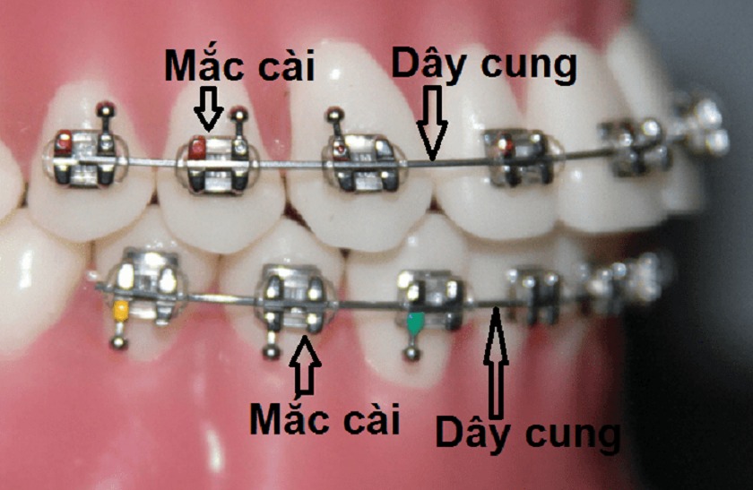 Dây cung niềng răng hợp kim kim loại quý