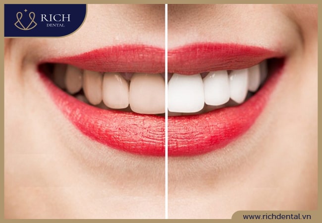 Phương pháp tẩy trắng răng Whitemax tại Rich Dental là sự lựa chọn tuyệt vời cho hàm răng của bạn