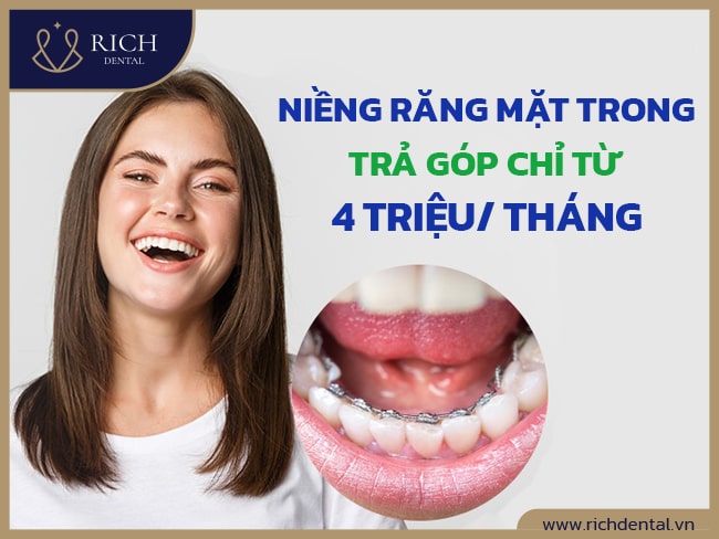 nieng-rang-mat-trong-tra-gop