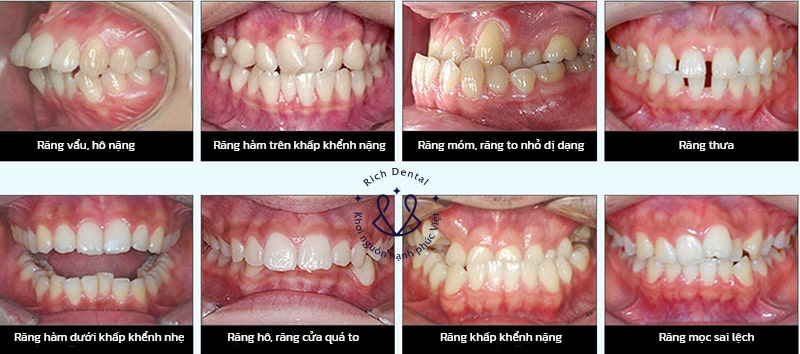nieng-rang-mat-trong