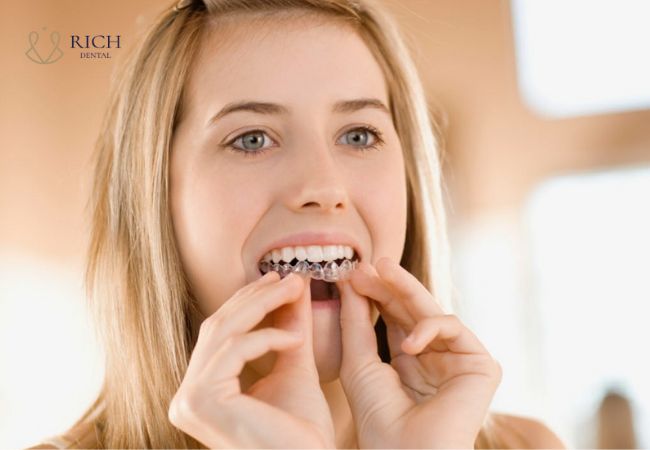 nieng-rang-invisalign