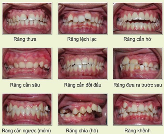 nieng-rang-v-line