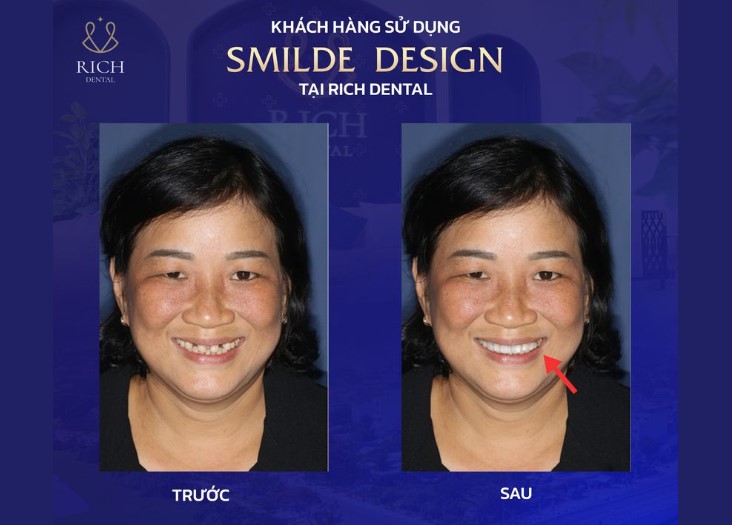 dan-rang-su-veneer-khong-mai-rang-gia-bao-nhieu